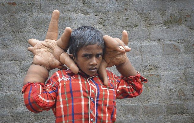 Мальчик с гигантскими руками