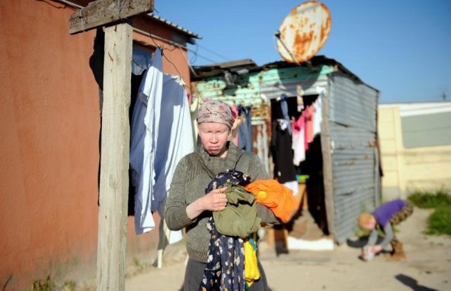 Как живется альбиносам в ЮАР