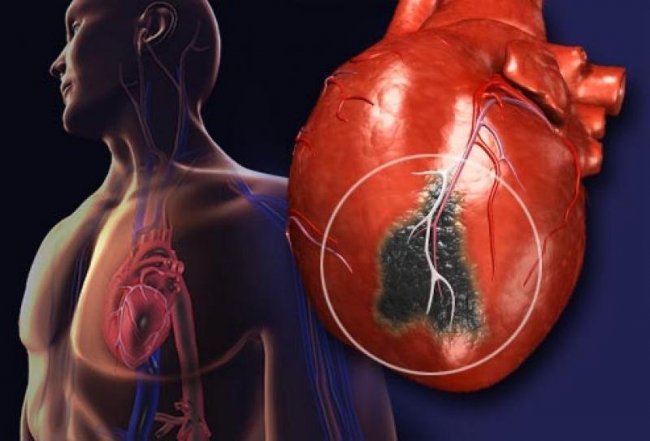 Учёными создан искусственный материал для замены «умершей» мышечной ткани после перенесённого инфаркта